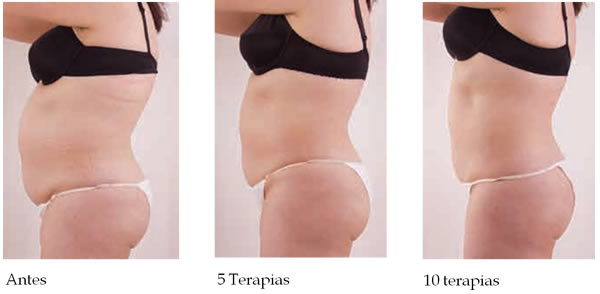 mesoterapia