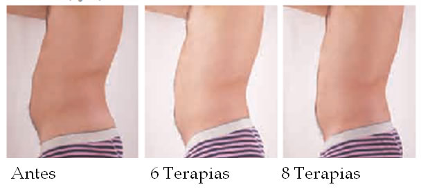 mesoterapia