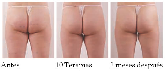 mesoterapia